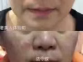 无针无痛祛皱抬头鱼尾川字鼻背法令纹脸部下垂提拉祛眼袋泪沟填充溶脂V脸瘦脸丰鼻子