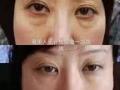 无针无痛祛皱抬头鱼尾川字鼻背法令纹脸部下垂提拉祛眼袋泪沟填充溶脂V脸瘦脸丰鼻子