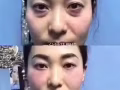 高科技，無需開刀動手術無痕去眼袋