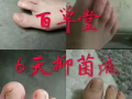 特效腳氣水，灰指甲，狐臭粉，祛痘膏，鼻炎膏，