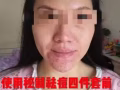 【苗家秘制祛痘膏】效果是寫在臉上,承諾15天無效退款