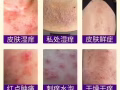马来膏，马来西亚鹰阁医院研发纯中药膏，治疗脚气，湿疹，痱子，蚊虫叮咬，皮炎。