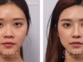 海鸥线拉提成就精致美鼻