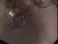 按摩 拔罐 推油减肥
