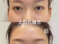 线雕鼻 瘦脸 嘟嘟唇水光针 买就送