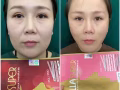 韓式微整新年大促銷咯
