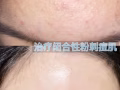 痘痘的克星