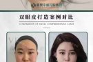 明星体验价$200任选以下的一个脸部项目（抬头纹,川字纹,提眉双眼皮,眼袋,水光针,瘦脸针,溶脂,去皱,填充下巴嘟嘟唇）