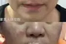 无针无痛祛皱抬头鱼尾川字鼻背法令纹脸部下垂提拉祛眼袋泪沟填充溶脂V脸瘦脸丰鼻子