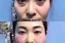 高科技，无需开刀动手术无痕去眼袋