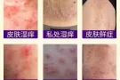 马来膏，马来西亚鹰阁医院研发纯中药膏，治疗脚气，湿疹，痱子，蚊虫叮咬，皮炎。