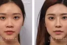 海鸥线拉提成就精致美鼻