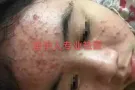 苗家祛痘膏