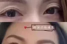 水光除皱抗衰提升