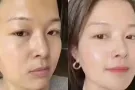 韩式微整大促销