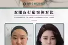 明星体验价$200任选以下的一个脸部项目（抬头纹,川字纹,提眉双眼皮,眼袋,水光针,瘦脸针,溶脂,去皱,填充下巴嘟嘟唇）