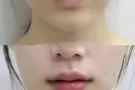 韩式微整v8线雕幼脸术8分钟提升大转变