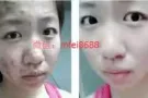 分享一下有着顽固痘痘的她秘诀就是用了唯尚颜全能祛痘膏没痘了