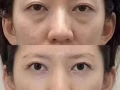 韩式微整圣诞大促销了