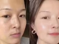 韩式微整大促销