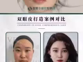 明星体验价$200任选以下的一个脸部项目（抬头纹,川字纹,提眉双眼皮,眼袋,水光针,瘦脸针,溶脂,去皱,填充下巴嘟嘟唇）