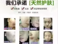 唯尚顏祛痘膏多少錢？怎麼辨別是否真品？