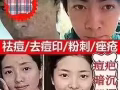 痘痘的克星