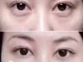 美容微整/嘟嘟唇/丰下巴/瘦脸/溶脂